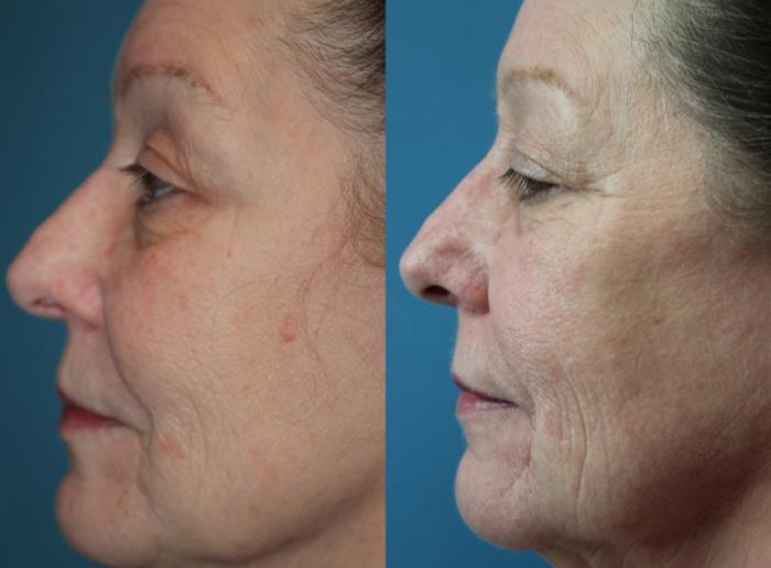 Before & After Laser Skin Rejuvenation Case 211 Left Side View in Coeur d'Alene, ID