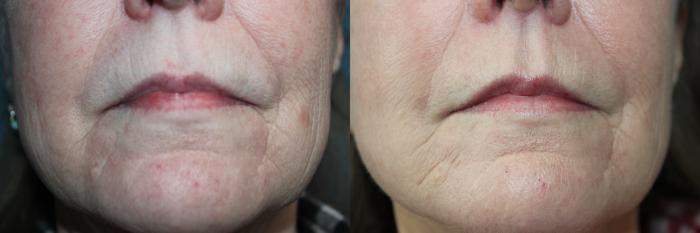 Before & After Laser Skin Rejuvenation Case 211 Mouth area close up View in Coeur d'Alene, ID