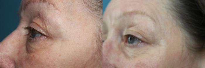 Before & After Laser Skin Rejuvenation Case 211 Oblique side eye View in Coeur d'Alene, ID