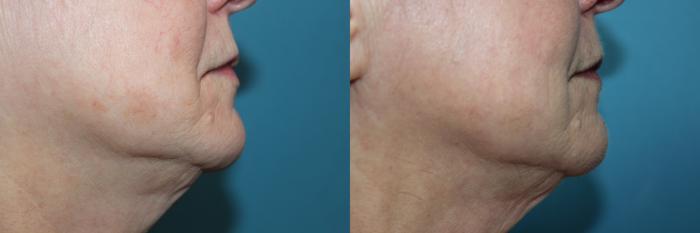 Before & After Laser Skin Rejuvenation Case 211 Right Cheek/Jawline  View in Coeur d'Alene, ID