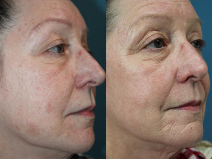 Before & After Laser Skin Rejuvenation Case 211 Right Side View in Coeur d'Alene, ID