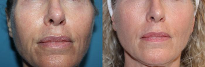 Before & After Laser Skin Rejuvenation Case 217 Back View in Coeur d'Alene, ID