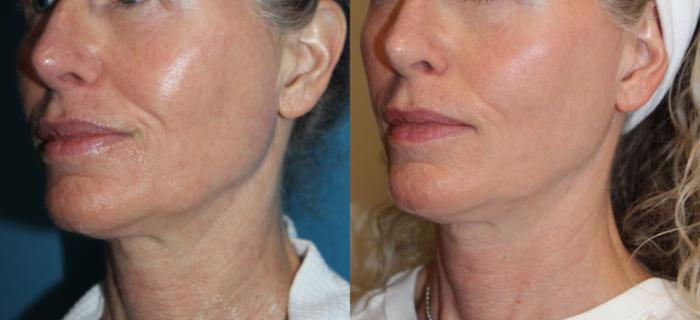 Before & After Laser Skin Rejuvenation Case 217 Left Oblique View in Coeur d'Alene, ID