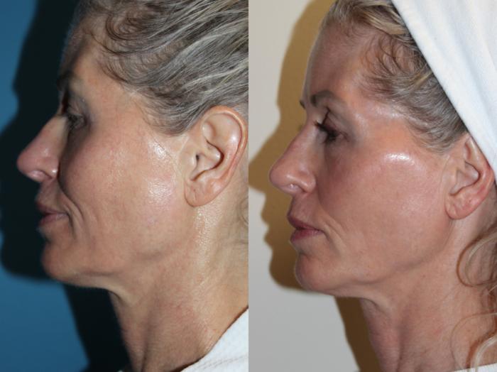 Before & After Laser Skin Rejuvenation Case 217 Left Side View in Coeur d'Alene, ID