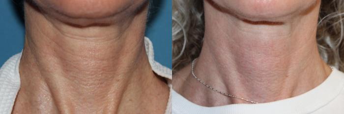Before & After Laser Skin Rejuvenation Case 217 Neck View in Coeur d'Alene, ID