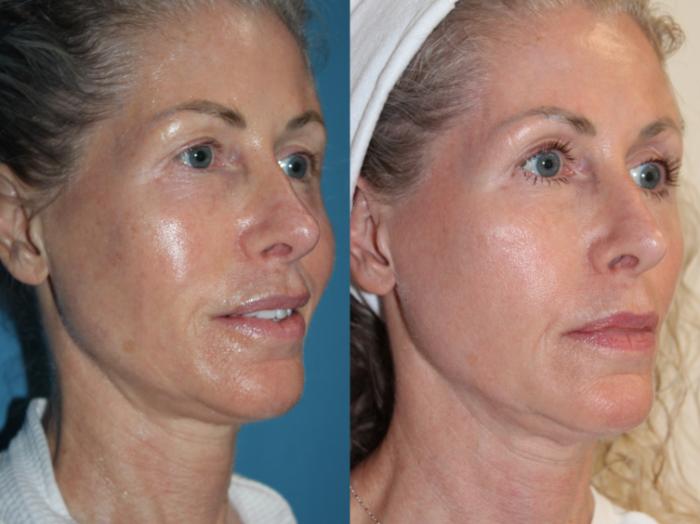 Before & After Laser Skin Rejuvenation Case 217 Right Oblique View in Coeur d'Alene, ID