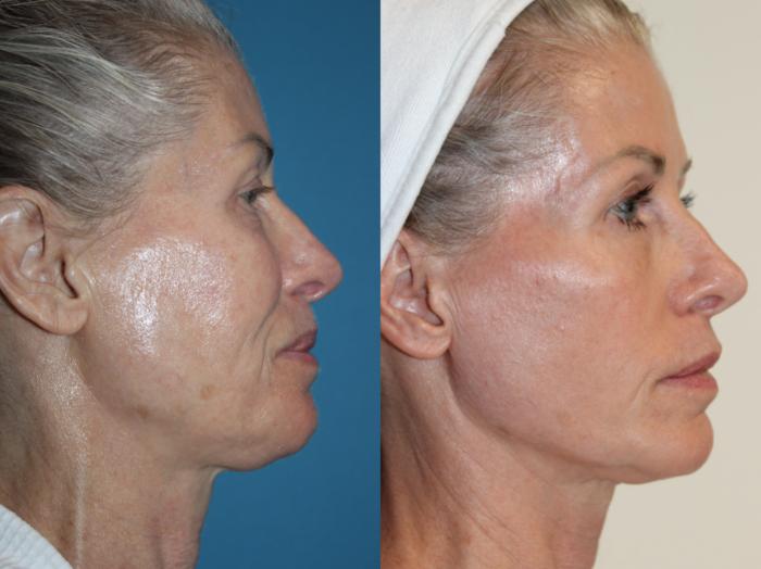 Before & After Laser Skin Rejuvenation Case 217 Right Side View in Coeur d'Alene, ID