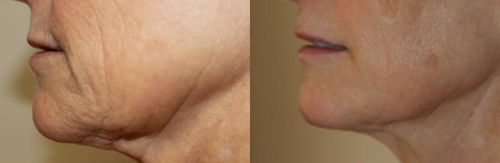 Before & After Laser Skin Rejuvenation Case 223 Left Side View in Coeur d'Alene, ID