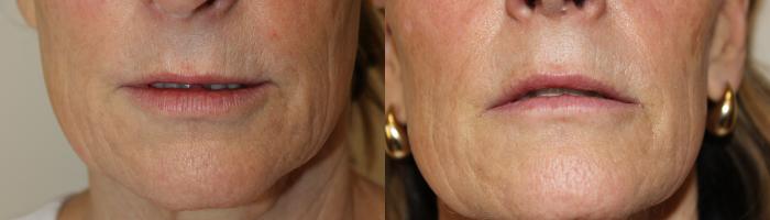 Before & After Laser Skin Rejuvenation Case 223 Mouth area View in Coeur d'Alene, ID