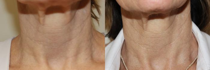 Before & After Laser Skin Rejuvenation Case 223 Neck View in Coeur d'Alene, ID