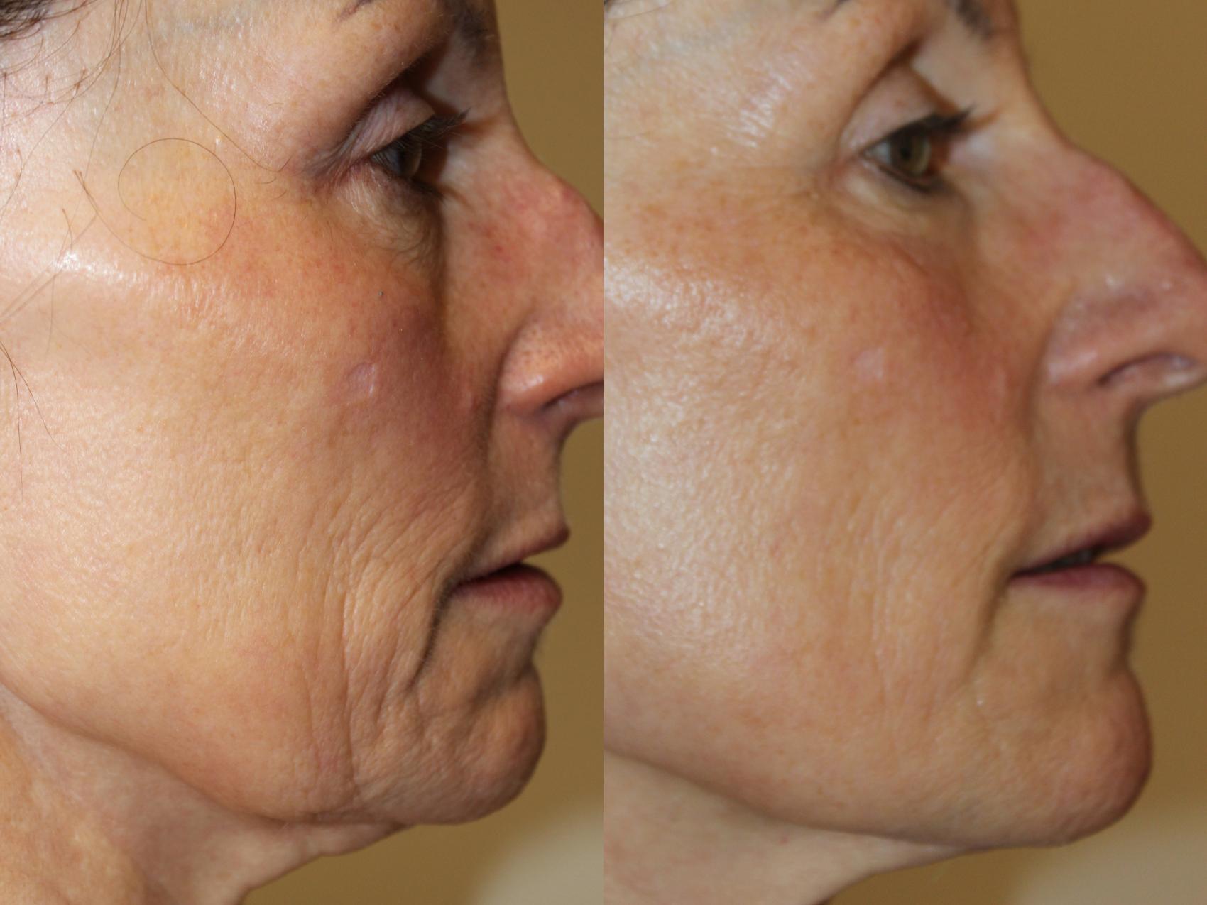 Before & After Laser Skin Rejuvenation Case 223 Right Side Full Face View in Coeur d'Alene, ID