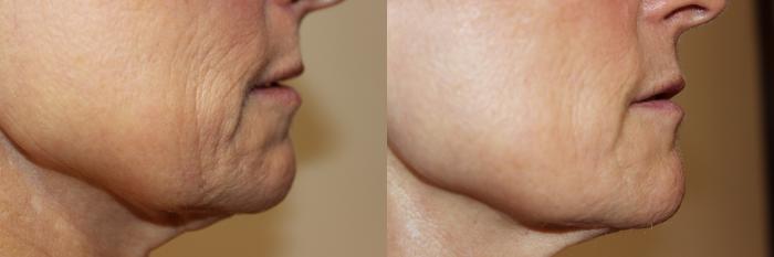 Before & After Laser Skin Rejuvenation Case 223 Right Side View in Coeur d'Alene, ID