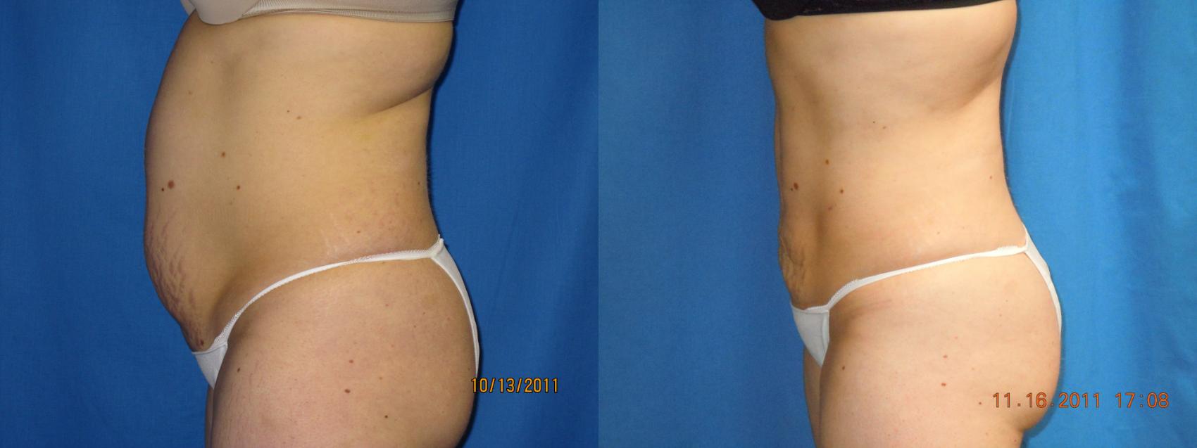 Before & After Laser Skin Rejuvenation Case 25 View #1 View in Coeur d'Alene, ID