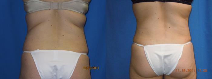 Before & After Liposuction - Abdomen / Flanks Case 25 View #2 View in Coeur d'Alene, ID