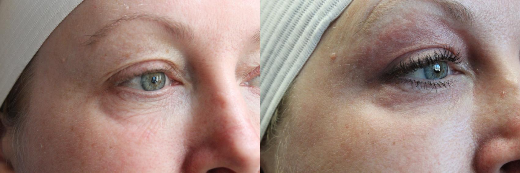 Before & After Laser Skin Rejuvenation Case 42 View #1 View in Coeur d'Alene, ID