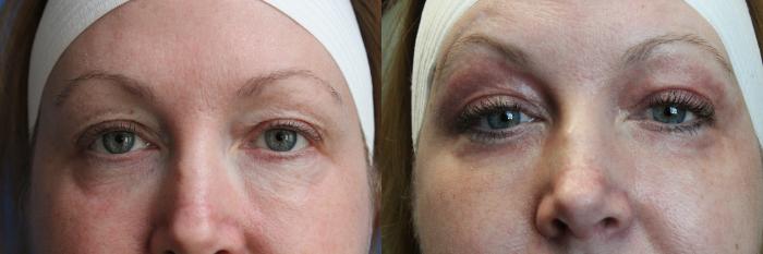 Before & After Laser Skin Rejuvenation Case 42 View #3 View in Coeur d'Alene, ID