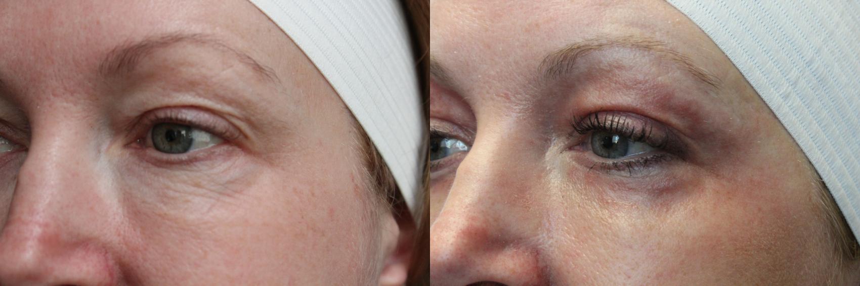 Before & After Laser Skin Rejuvenation Case 42 View #4 View in Coeur d'Alene, ID