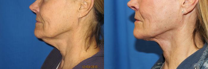 Before & After Laser Skin Rejuvenation Case 49 View #2 View in Coeur d'Alene, ID