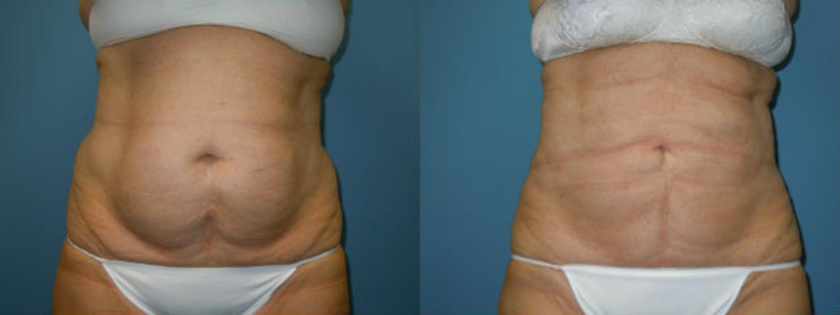 Before & After Liposuction - Abdomen / Flanks Case 102 View #1 View in Coeur d'Alene, ID