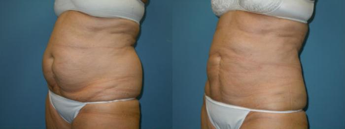 Before & After Liposuction - Abdomen / Flanks Case 102 View #2 View in Coeur d'Alene, ID