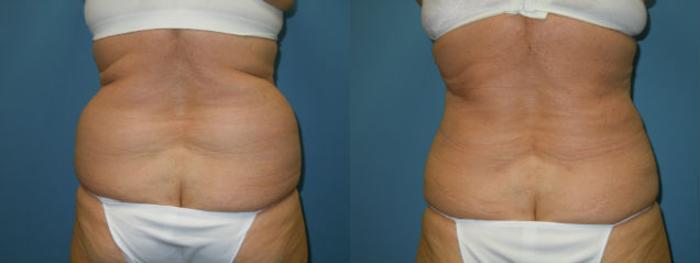 Before & After Liposuction - Abdomen / Flanks Case 102 View #3 View in Coeur d'Alene, ID