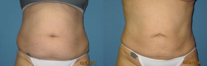 Before & After Liposuction - Abdomen / Flanks Case 106 View #1 View in Coeur d'Alene, ID