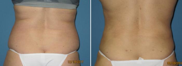 Before & After Liposuction - Abdomen / Flanks Case 106 View #2 View in Coeur d'Alene, ID