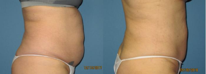 Before & After Liposuction - Abdomen / Flanks Case 106 View #3 View in Coeur d'Alene, ID