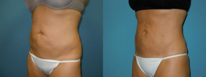 Before & After Liposuction - Abdomen / Flanks Case 108 View #1 View in Coeur d'Alene, ID