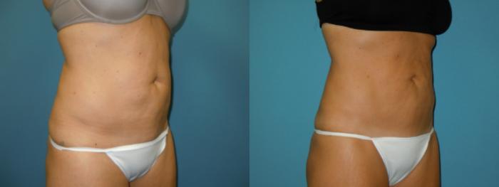 Before & After Liposuction - Abdomen / Flanks Case 108 View #2 View in Coeur d'Alene, ID