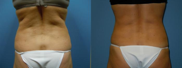 Before & After Liposuction - Abdomen / Flanks Case 108 View #3 View in Coeur d'Alene, ID
