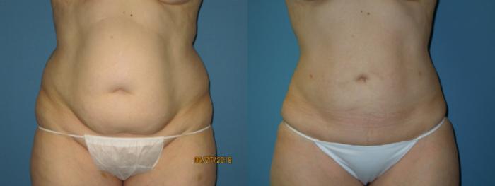 Before & After Liposuction - Abdomen / Flanks Case 109 View #1 View in Coeur d'Alene, ID