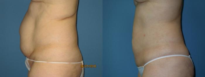 Before & After Liposuction - Abdomen / Flanks Case 109 View #2 View in Coeur d'Alene, ID
