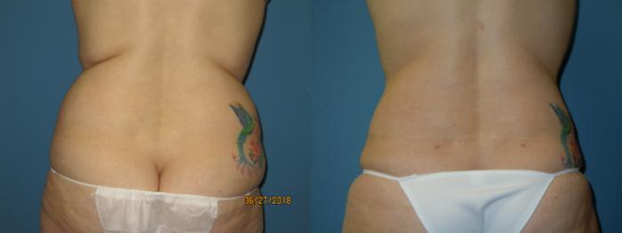 Before & After Liposuction - Abdomen / Flanks Case 109 View #3 View in Coeur d'Alene, ID
