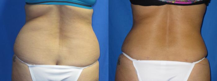Before & After Liposuction - Abdomen / Flanks Case 11 View #1 View in Coeur d'Alene, ID