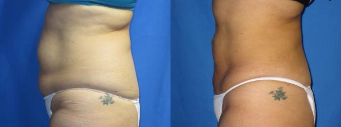 Before & After Liposuction - Abdomen / Flanks Case 11 View #2 View in Coeur d'Alene, ID