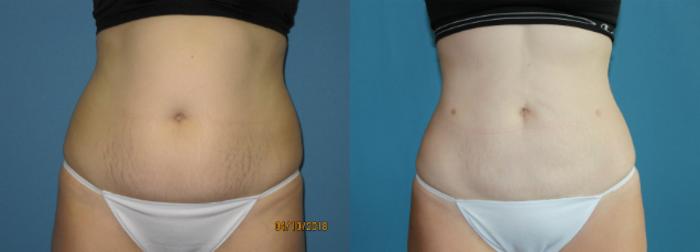 Before & After Liposuction - Abdomen / Flanks Case 111 View #1 View in Coeur d'Alene, ID
