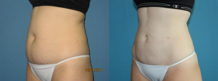 Before & After Liposuction - Abdomen / Flanks Case 111 View #2 View in Coeur d'Alene, ID