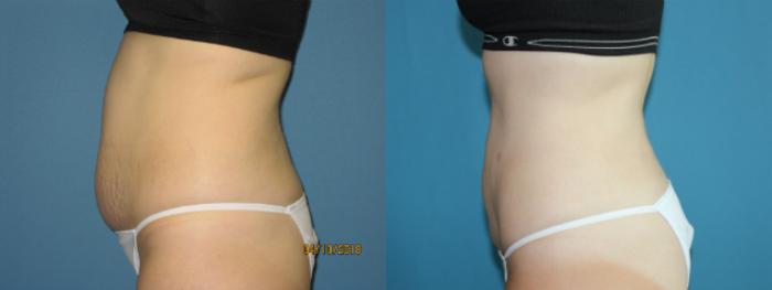 Before & After Liposuction - Abdomen / Flanks Case 111 View #3 View in Coeur d'Alene, ID