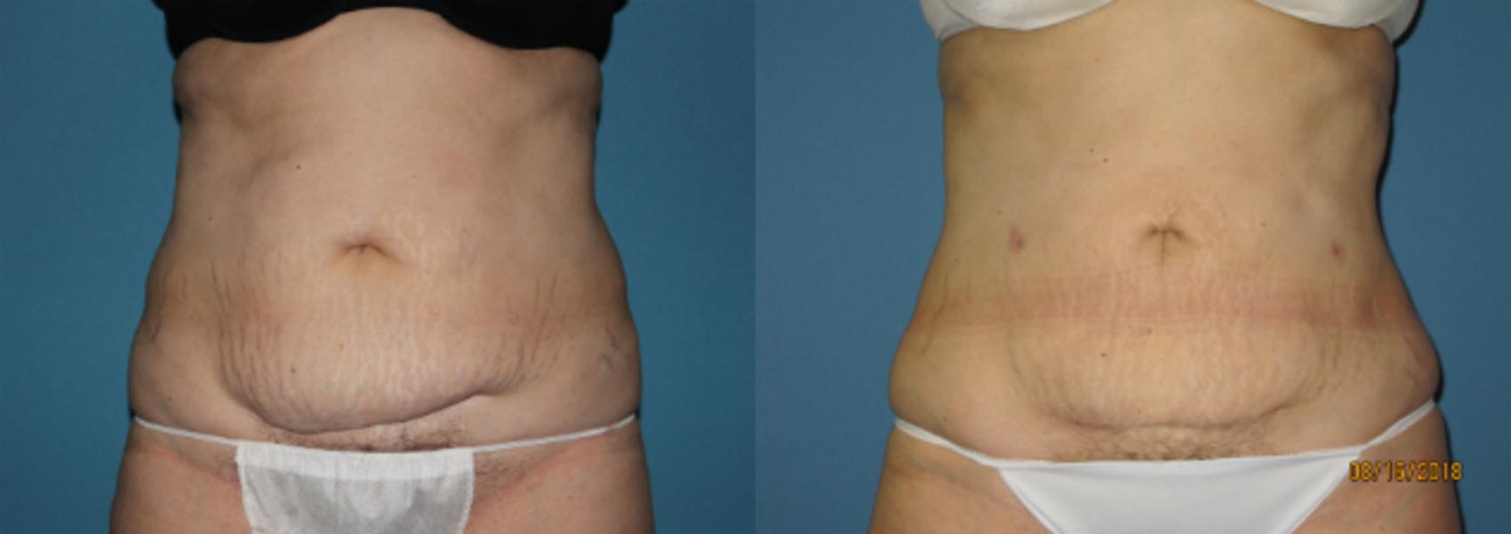 Before & After Liposuction - Abdomen / Flanks Case 112 View #1 View in Coeur d'Alene, ID