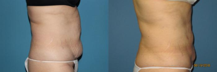 Before & After Liposuction - Abdomen / Flanks Case 112 View #2 View in Coeur d'Alene, ID