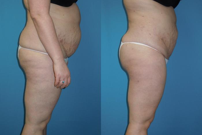Before & After Liposuction - Abdomen / Flanks Case 125 View #1 View in Coeur d'Alene, ID