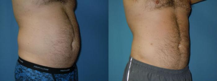 Before & After Liposuction - Abdomen / Flanks Case 129 View #1 View in Coeur d'Alene, ID