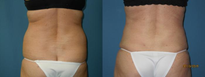 Before & After Liposuction - Abdomen / Flanks Case 131 View #1 View in Coeur d'Alene, ID