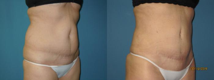 Before & After Liposuction - Abdomen / Flanks Case 131 View #2 View in Coeur d'Alene, ID