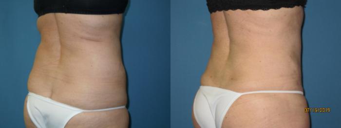 Before & After Liposuction - Abdomen / Flanks Case 131 View #3 View in Coeur d'Alene, ID