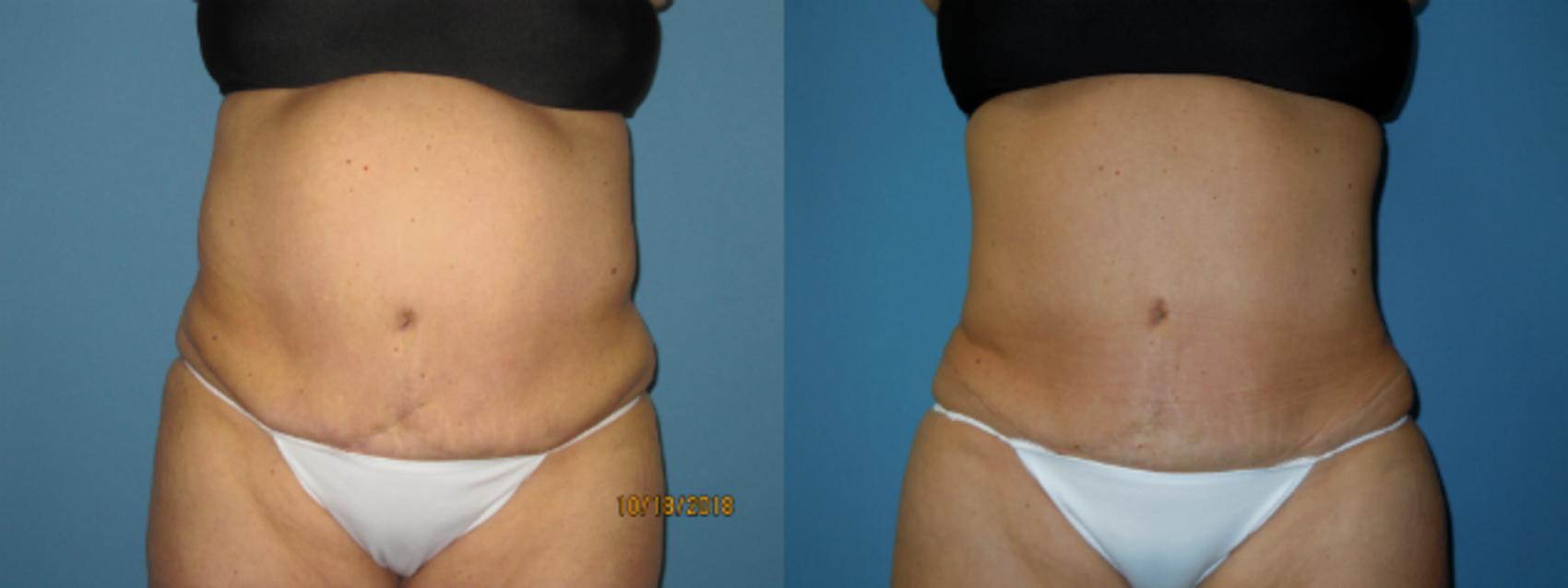 Before & After Liposuction - Abdomen / Flanks Case 134 View #1 View in Coeur d'Alene, ID