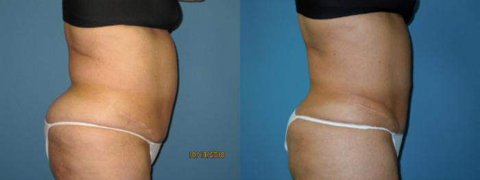 Before & After Liposuction - Abdomen / Flanks Case 134 View #2 View in Coeur d'Alene, ID
