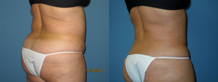 Before & After Liposuction - Abdomen / Flanks Case 134 View #3 View in Coeur d'Alene, ID