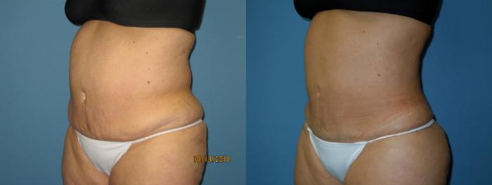 Before & After Liposuction - Abdomen / Flanks Case 134 View #4 View in Coeur d'Alene, ID